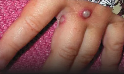 Mesure de sécurité - Variole du singe : Maurice commande déjà ses vaccins