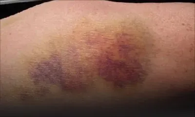 Après une chute : blessée dans un supermarché elle sera indemnisée