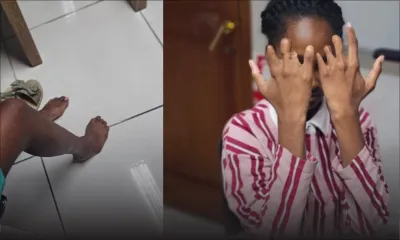 Née avec une malformation aux mains et au pied droit : Abigaelle, 17 ans, privée  de sa pension d’invalidité