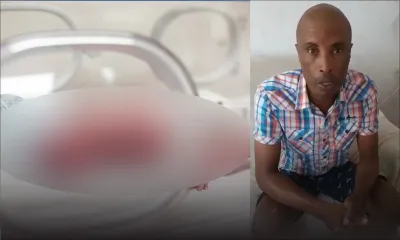 Le bébé atteint de malformation nécessitant une intervention en Inde décède 