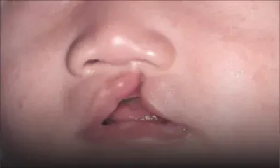 Trou-aux-Biches : le «bec-de-lièvre» au centre d’une journée de sensibilisation et d'information