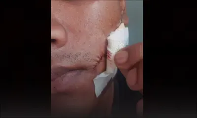 Mahébourg : un présumé pervers sexuel lui taillade la joue 