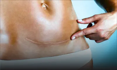 Births by caesarian section: Reasons behind the rising trend