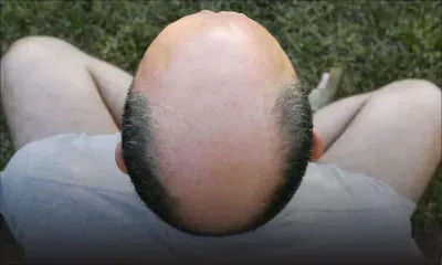 Angleterre : traiter un homme de «chauve» constitue un harcèlement sexuel, selon un tribunal du travail 