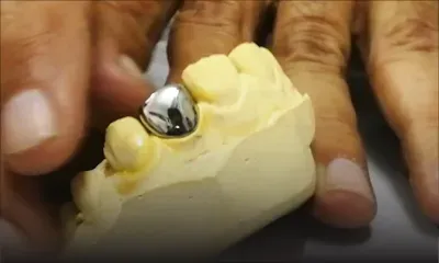 Blanchiment d’argent : ces dents en platine qui coûtent une fortune