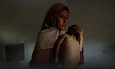 Un enfant sur cinq dans la ville de Gaza souffre de malnutrition, selon une agence de l’ONU 