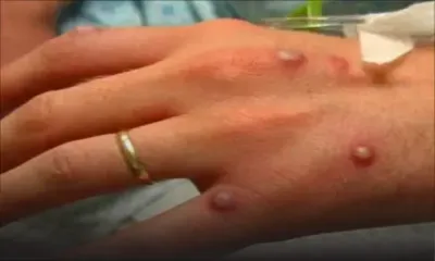 Variole du singe : risque « très faible » d'une vaste contagion, selon une agence européenne