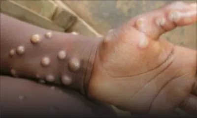 Variole du singe : de nouveaux cas chaque jour au Royaume-Uni