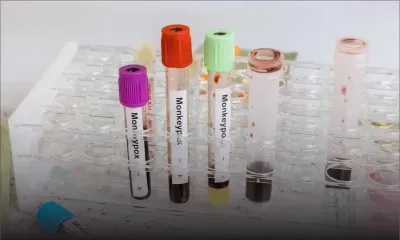 Variole du singe: 1 000 cas, l'OMS craint que le virus s'installe dans les pays non endémiques