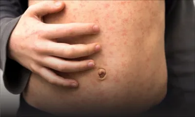 Rougeole : la vigilance est de mise