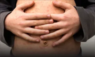 Deux morts et plus de 200 cas en pleine épidémie de rougeole aux Etats-Unis