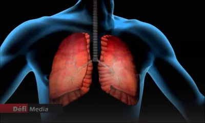 Tuberculose - un cas détecté et les 17 autres tests négatifs : «La situation est sous contrôle», indique le ministère de la Santé