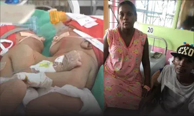 Bébés siamois à Bangalore : le couple Papillon convoqué par les médecins de l’hôpital