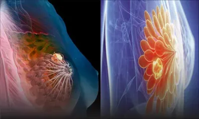 Comment surmonter un cancer du sein?