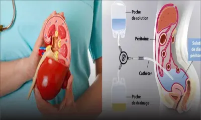 Insuffisance rénale : tout savoir sur la dialyse