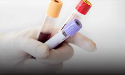 Aucun cas de variole du singe à Maurice