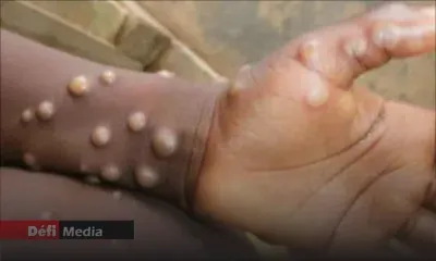 Variole du singe : situation « atypique » mais transmission possible à stopper, selon l'OMS