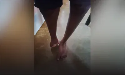 Paiement de pension interrompu : Aneesha lutte pour les droits de sa fille née avec un seul pied