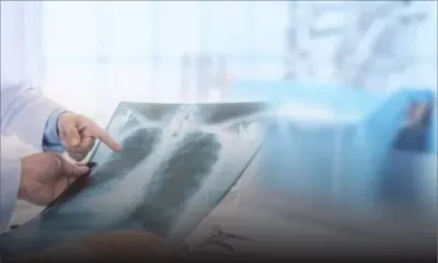 Tuberculose: le gel de l'aide américaine met en danger des millions de vie, selon l'OMS