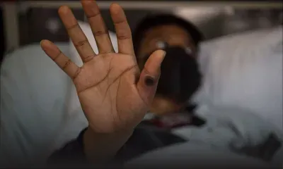 Variole du singe: l'EMA autorise la technique d'injection du vaccin intradermique avec une dose moindre