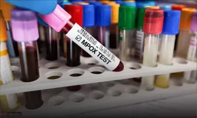 Santé : un premier cas de Mpox à Maurice (cas importé)