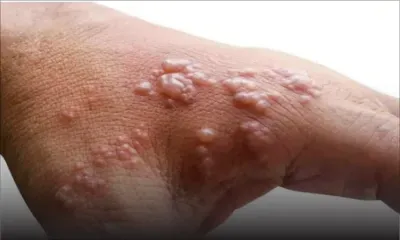 Variole du singe : l'UE prépare des achats groupés de vaccins 