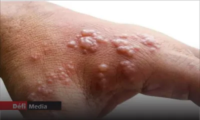 Variole du singe : les procédures enclenchées pour l’obtention de 1000 vaccins 