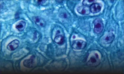 Variole du singe: un premier cas d'infection confirmé en France