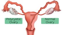 Polycystic Ovary Syndrome : Complicated Medical Condition but Can Be Treated