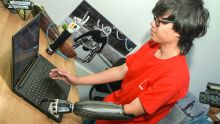 Ottobock Mauritius : bionic hand prosthesis arrives in Mauritius