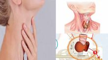 Thyroïde : Quels examens faire pour dépister et diagnostiquer ?