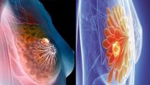 Comment surmonter un cancer du sein?