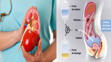 Insuffisance rénale : tout savoir sur la dialyse