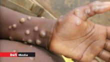 Variole du singe : situation « atypique » mais transmission possible à stopper, selon l'OMS