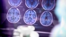 Résultats positifs confirmés pour un médicament anti-Alzheimer
