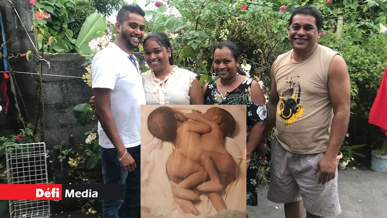 Séparé de son frère siamois - Ashlay Fokeer, 26 ans : «Je suis un survivant»