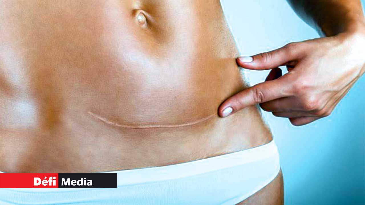 Births by caesarian section: Reasons behind the rising trend