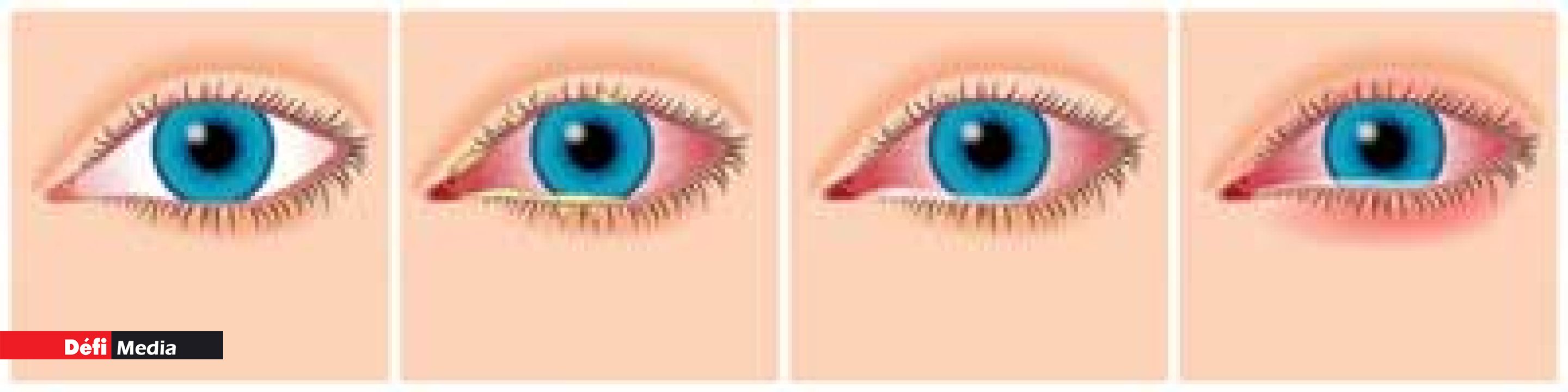 Types of Conjunctivitis